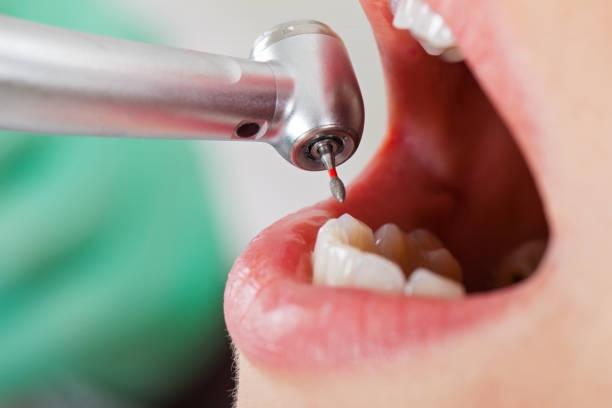 Best Emergency Gum Treatment in Cloverdale, CA